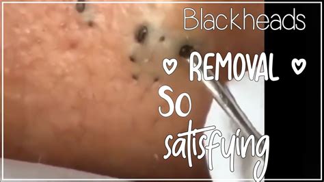 why is blackhead removal satisfying|Why Are So Many People Turning to Extraction Videos Right .